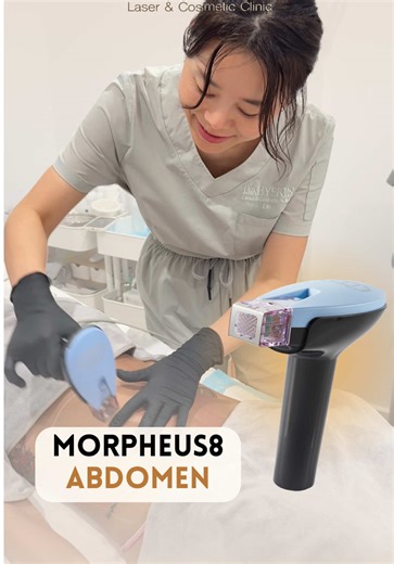 ✨ Morpheus8 Body is a cutting-edge radio-frequency microneedling procedure that delivers RF energy deep into the dermis for smoother, tighter, and more youthful-looking skin. 🔹 What makes it unique? ✅ Burst Technology: Delivers RF energy at three different depths in a single pulse for more effective skin, tissue, fat, and collagen remodeling. ✅ Scale Technology: Allows precise customization of RF energy levels to target different areas and skin types effectively. ✅ FDA-approved for deep 8mm sub