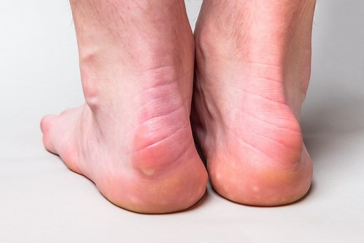 What Causes Bumps on the Heel? | Family Foot Care & Surgery