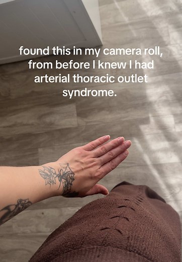 Arterial Thoracic Outlet Syndrome: Hand Turning Dark Before Diagnosis
