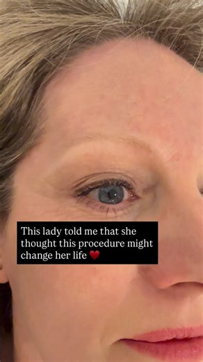 LONDON BROW CLINIC on Instagram: "Fresh and natural microblading by Galata at LondonBrowClinic We work over the top of work by other artists too! £395 FIRST SET £195 TOP UP ON WORK BY ANOTHER ARTIST We are based on High St Kensington at The Royal Garden Hotel MediSpa BOOK BY CLICKING ON THE LINK We are London’s only microblading specialist clinic Medical pedigree 10 years of experience Thousands of active clients Microblading benefits women by providing a convenient and long-lasting solution to