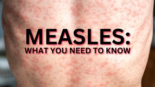 Measles: What it is, how it spreads and what to do if you suspect it