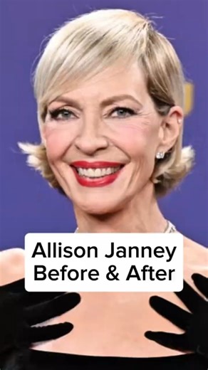 Allison Janney Before and After #shorts #allisonjanney #plasticsurgery