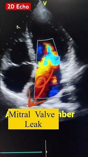Normal, Leak and Tight Mitral Valve Echo #echo #angiography #shorts