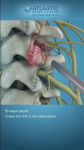 What is Endoscopic Facet Rhizotomy? #Short