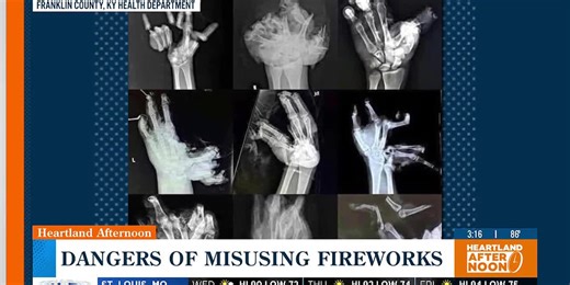 Avoid a ‘life-changing’ injury: Dangers of misusing fireworks