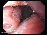 Enlarged Tonsils (1 of 2) • Video • MEDtube.net