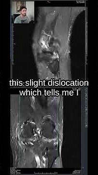 This Knee Has No ACL And Here's How We Know