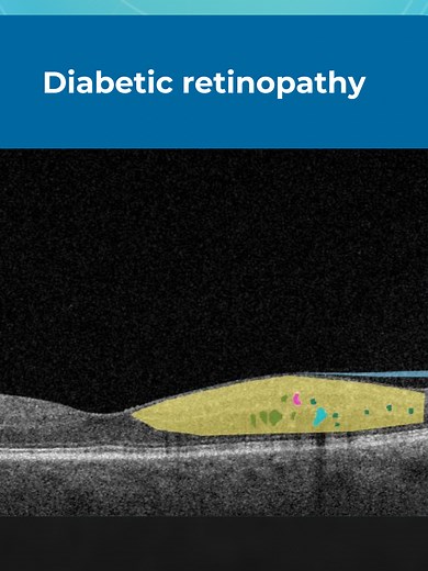 🧠 OCT Knowledge Check: Witness how Altris AI analyzes OCT scans and highlights pathology biomarkers! 🤯 This is just a glimpse of its full capabilities, which include disease progression tracking, precise measurements, and early glaucoma risk analysis. Ready to explore the full potential of AI for OCT? Check out our free demo with real-world scans (link in bio)! 👀 You can check how the platform works on real-world scans in our free demo (link in bio) #octchallenge #Optometrist #Ophthalmologist