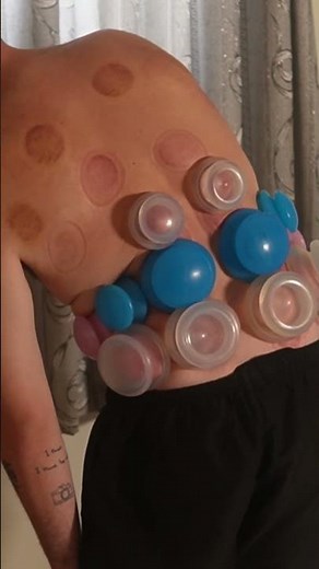 Special Cupping Technique for Lower Back Pain & Stiffness