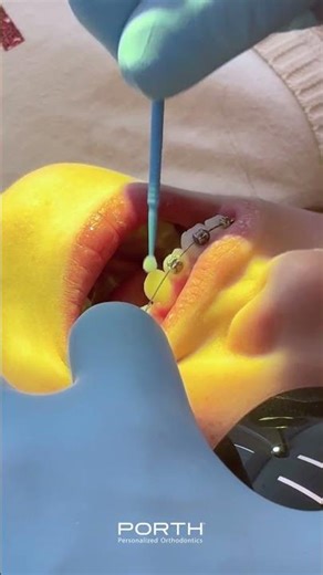 The Art of Moving Teeth to Its Perfect Spot 🦷🎯