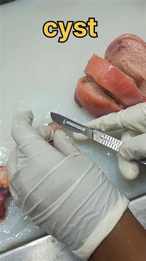 Cyst cutting 🧐| #histopathology #ovariancyst #cyst #tubalcyst #fallopiantubeblockage #fallopiantube