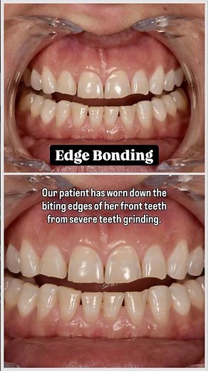 Edge bonding with composite resin #dentist