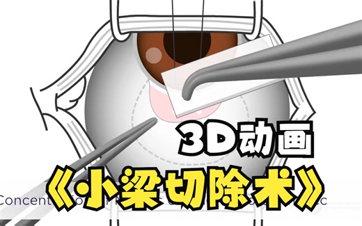 【3D动画】小梁切除术 Trabeculectomy