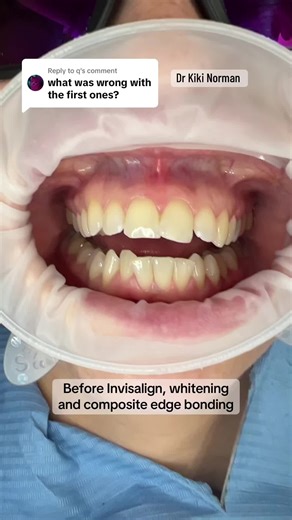 Transform Your Smile: Invisalign and Composite Bonding Results