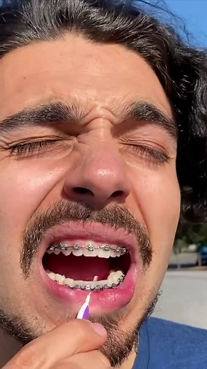 Hilarious Moments of People with Braces | Brace Yourself for Laughter!