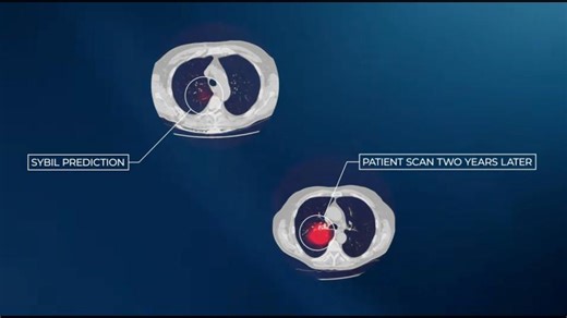 How AI predicts lung cancer risk 6 years in advance (2 min) | Eduardo E Chang MD, M.