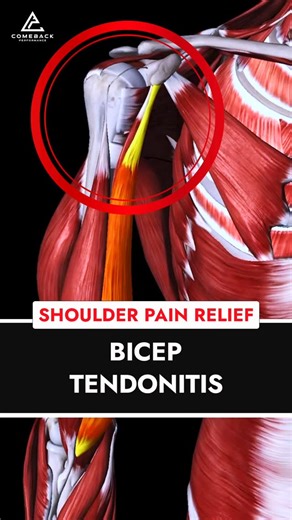 Dr. Joey Seyforth PT, DPT, ATC, CSCS on Instagram: "💥 What Is Bicep Tendonitis and How Can You Fix It? 💥 ❌ Struggling with shoulder pain that radiates to your upper arm? You might be dealing with bicep tendonitis—an inflammation or irritation of the tendon connecting your bicep to your shoulder. Here’s what you need to know: 🎯 What Is Bicep Tendonitis? It’s often caused by overuse, poor shoulder mechanics, or repetitive motions. The result? Pain, weakness, and discomfort in the front of your