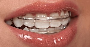 Inman Aligner Cost, Reviews, and Before and After Treatment - Dentaly.org