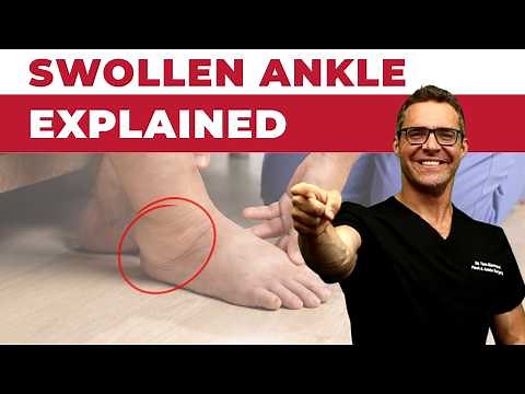 Why Is My Sprained Ankle Still Swollen? [After 3, 6 or 12+ MONTHS!]