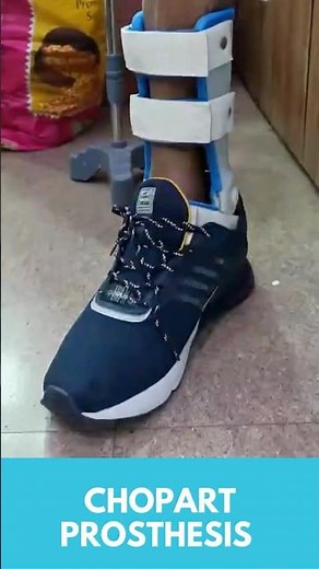 Chopard Prosthesis | Regain Ankle Movement & Comfortable Walking