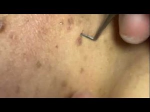 We’re Back! Raw & Real Ingrown Removal You’ve Missed | Ep. 11