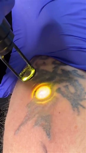 Laser tattoo removal - Peterborough, UK