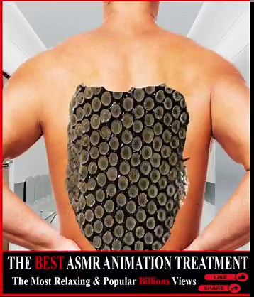 O.M.G😲 This Guy's Back Badly Severely Infected By Trypophobia Parasite & Maggots | Lline Theodora
