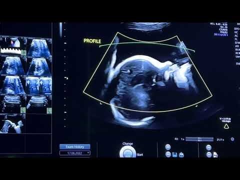 CELEBRATING THE INTERNATIONAL DAY OF THE UNBORN CHILD//Our son at 33 Weeks Gestation ❤️//#fetus