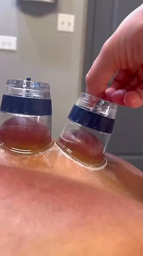 🏆Cupping therapy uses suction to lift and decompress layers of fascia and muscle, helping improve blood flow, reduce stiffness, and ease deep muscle tension. Great for recovery and stress relief—sometimes you need to pull to release. #CuppingTherapy #MyofascialRelease #ChicagoChiropractic #ChiropracticCare #drkyleross | Dr_kyleross
