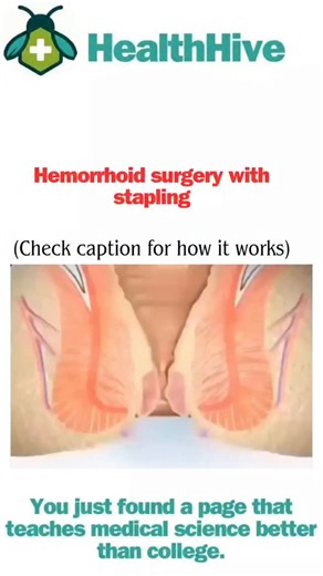 HealthHive on Instagram: "Stapled hemorrhoidopexy (or procedure for prolapse and hemorrhoids, PPH) is a modern surgical technique to treat severe hemorrhoids with less pain and faster recovery than traditional removal. How it works: · A circular stapler is inserted into the anal canal. · The device pulls the prolapsed hemorrhoidal tissue upward and removes a ring of excess tissue. · Simultaneously, it staples the remaining tissue back into place, cutting off blood supply to the hemorrhoids so th