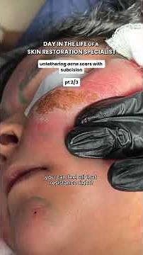 DITL of a Skin Restoration Specialist: Performing Subcision #AcneScars #IcePickScars