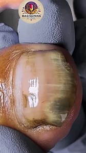 Nail Care Guide: Insurance-Friendly Support for Ongoing Needs 💖 #NailCareGuide #InsuranceEducation #HealthEducation | Basiquinha