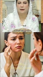Instant Pimple Removal at Home | Salt Water Remedy for Acne | Quick Pimple Hack