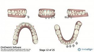 See the Progress of This Woman's Teeth After Using Invisalign