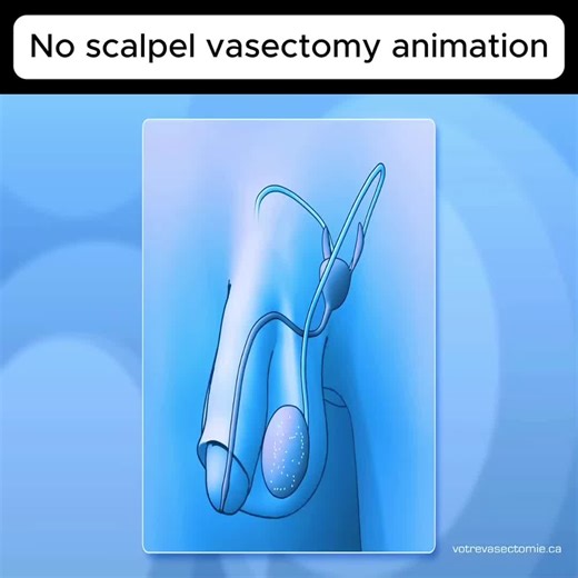 No Scalpel Vasectomy Animation #fyp #foryou #health #scalpel #animation