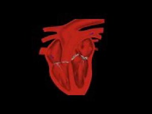 Auscultation: stenose pulmonaire