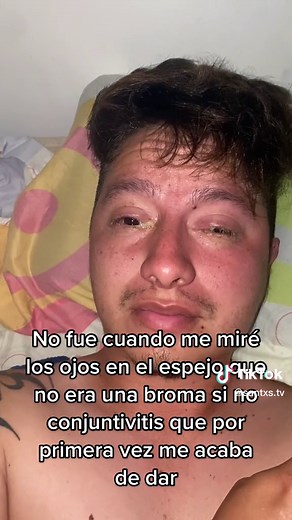 Conjuntivitis y ojos pegados: ¿qué hacer?