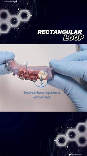 Gustavo Gameiro | Orthodontic Biomechanics on Instagram: "Derotating molars — clockwise or counterclockwise — becomes surprisingly simple when you understand rectangular loops. When only couples are required, Geometry VI delivers clean and efficient control. If buccal or lingual forces are needed, then Geometry IV or V comes into play — depending on the biomechanical goal. 👉 The key takeaway: Rectangular loops are one of the most versatile tools for precise first-order movements — when the forc