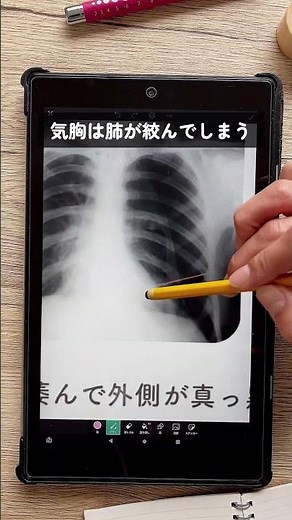 【みれる？肺のレントゲン見方のポイント】#看護 #医療 #看護師2年目 #看護師 #看護師勉強垢 #新人看護師#レントゲン