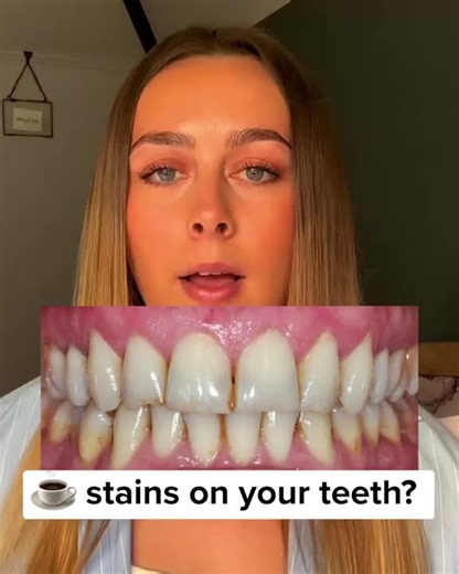 Smile Therapy Ultrasonic Electric Tooth Cleaner - | Plaque Remover for Teeth, Gentle Ultrasonic Cleaner, & Flosser #teethwhitening #teethwhiten #smilemakeover #oralhygiene #cleaningproducts #menshygiene #purpleteethwhitening #whiteningteeth #snowteethwhitening #bestcurlingwand