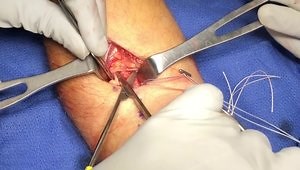 Distal Biceps Repair