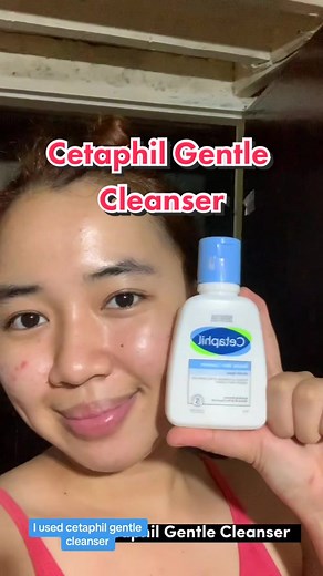 Say Goodbye to Pimple Marks with Cetaphil Gentle Cleanser
