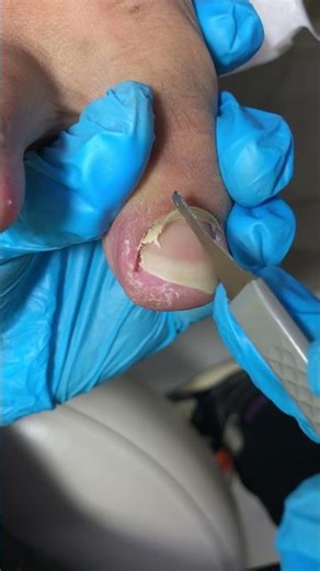 Extra-long toenails, trimmed along the gaps! #nails
