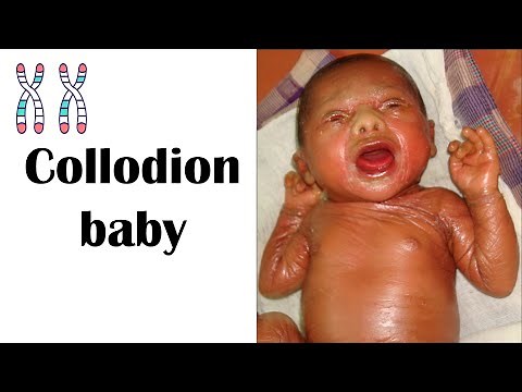 Collodion Baby Causes, Risk Factors, Complications, & Treatment
