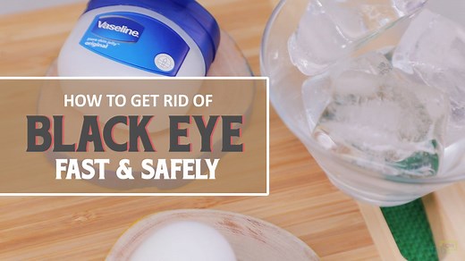 Easy & Effective Methods to Get Rid of a Black Eye | Fab How