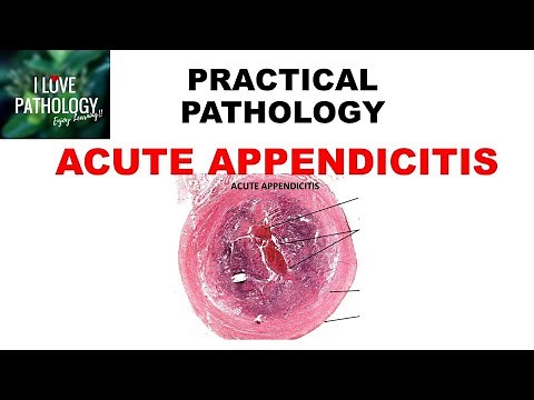 ACUTE APPENDICITIS: Etiopathogenesis, clinical features & morphology