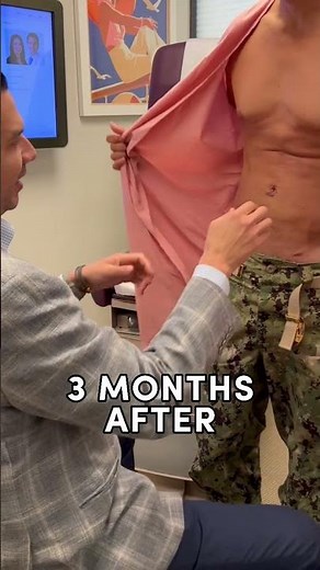 See How HD Lipo Helped This Patient Lose Over 20 lbs! | La Jolla Cosmetic Surgery Centre