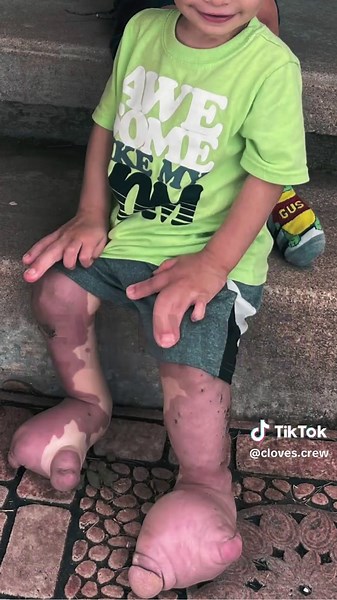 Understanding Cloves Syndrome: Common Manifestations of the PIK3CA Mutation