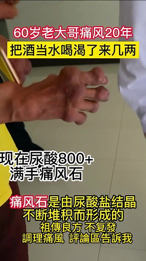 中藥調理痛風：清除痛風石的方法