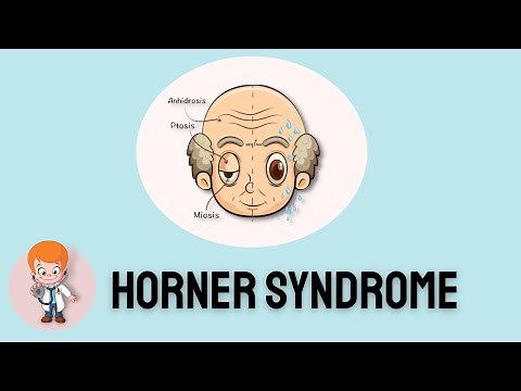 Horner Syndrome: Signs and symptoms and insights